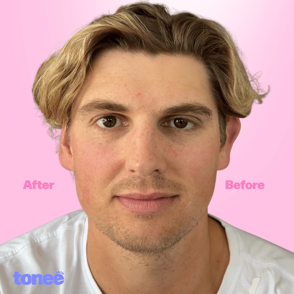 Tonee Ears by Tonee Skin - cellulite smoothing, lifting, and firming tape for