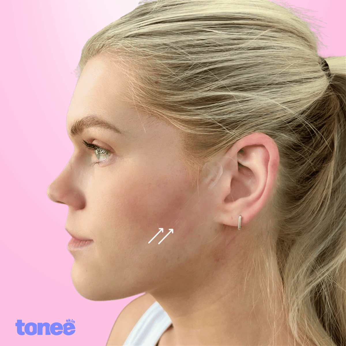 Tonee Face by Tonee Skin - cellulite smoothing, lifting, and firming tape for