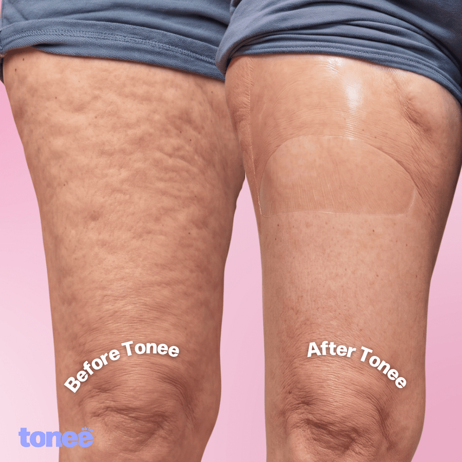 Tonee Legs & Booty by Tonee Skin - cellulite smoothing, lifting, and firming tape for