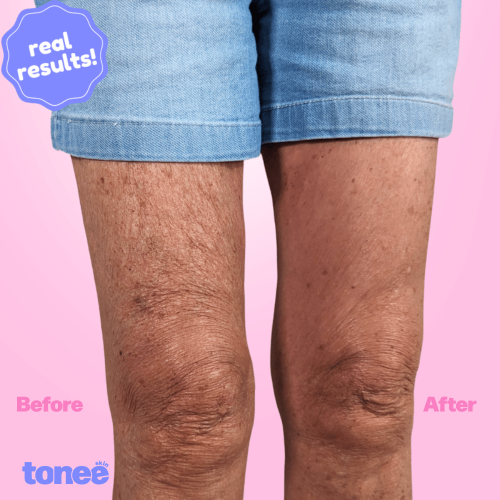 Tonee Legs & Booty by Tonee Skin - cellulite smoothing, lifting, and firming tape for