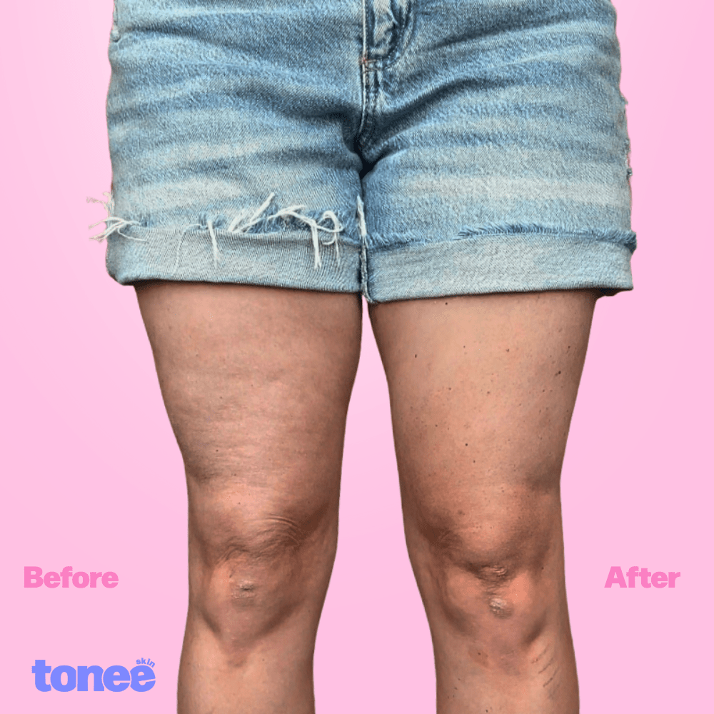 Tonee Legs & Booty by Tonee Skin - cellulite smoothing, lifting, and firming tape for