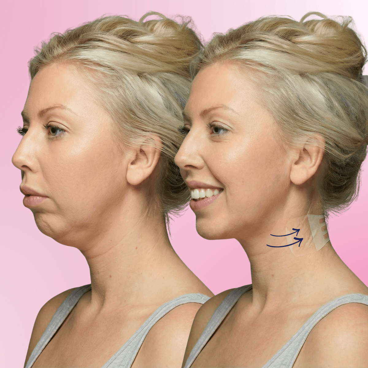 Tonee Neck by Tonee Skin - cellulite smoothing, lifting, and firming tape for