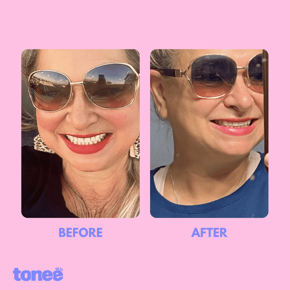 Tonee Neck by Tonee Skin - cellulite smoothing, lifting, and firming tape for