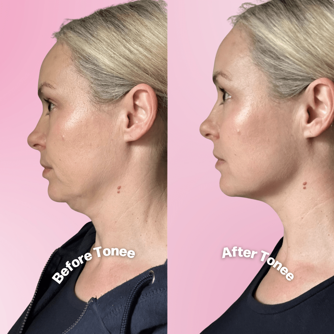 Tonee Neck by Tonee Skin - cellulite smoothing, lifting, and firming tape for