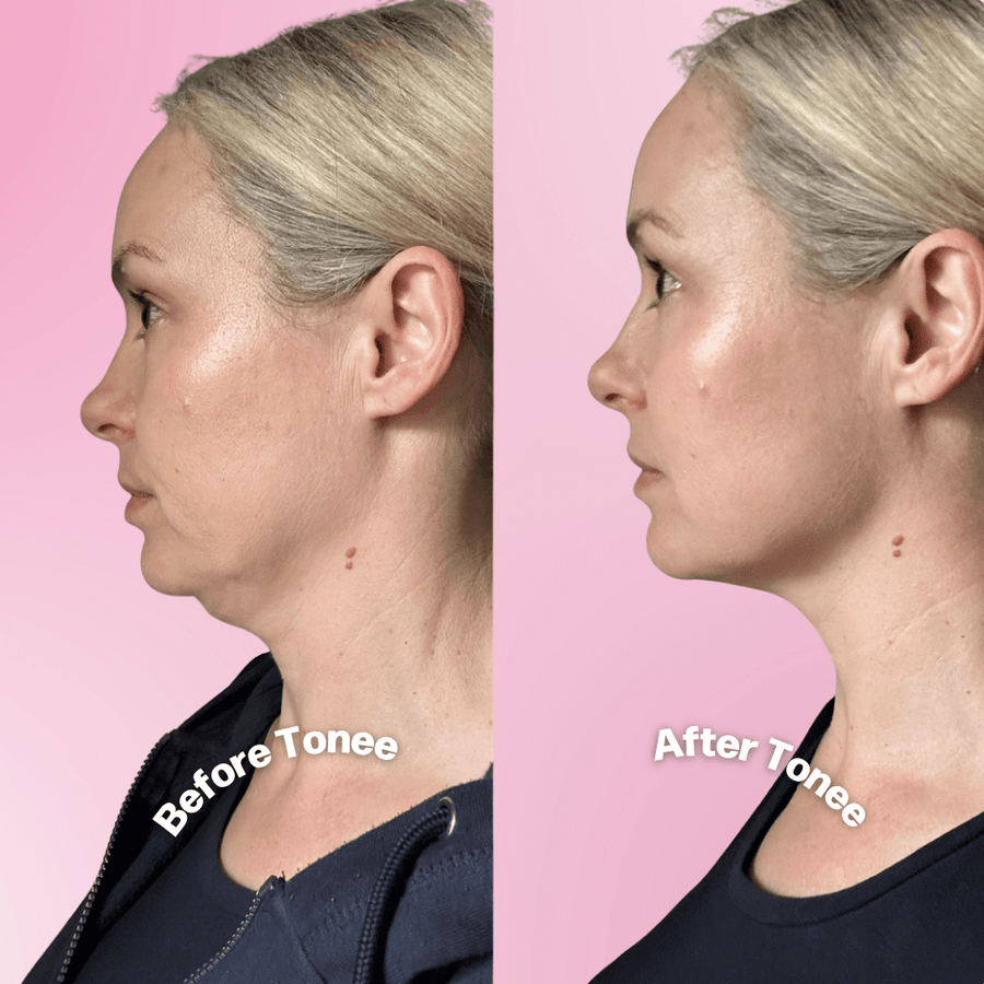 Tonee Neck by Tonee Skin - cellulite smoothing, lifting, and firming tape for