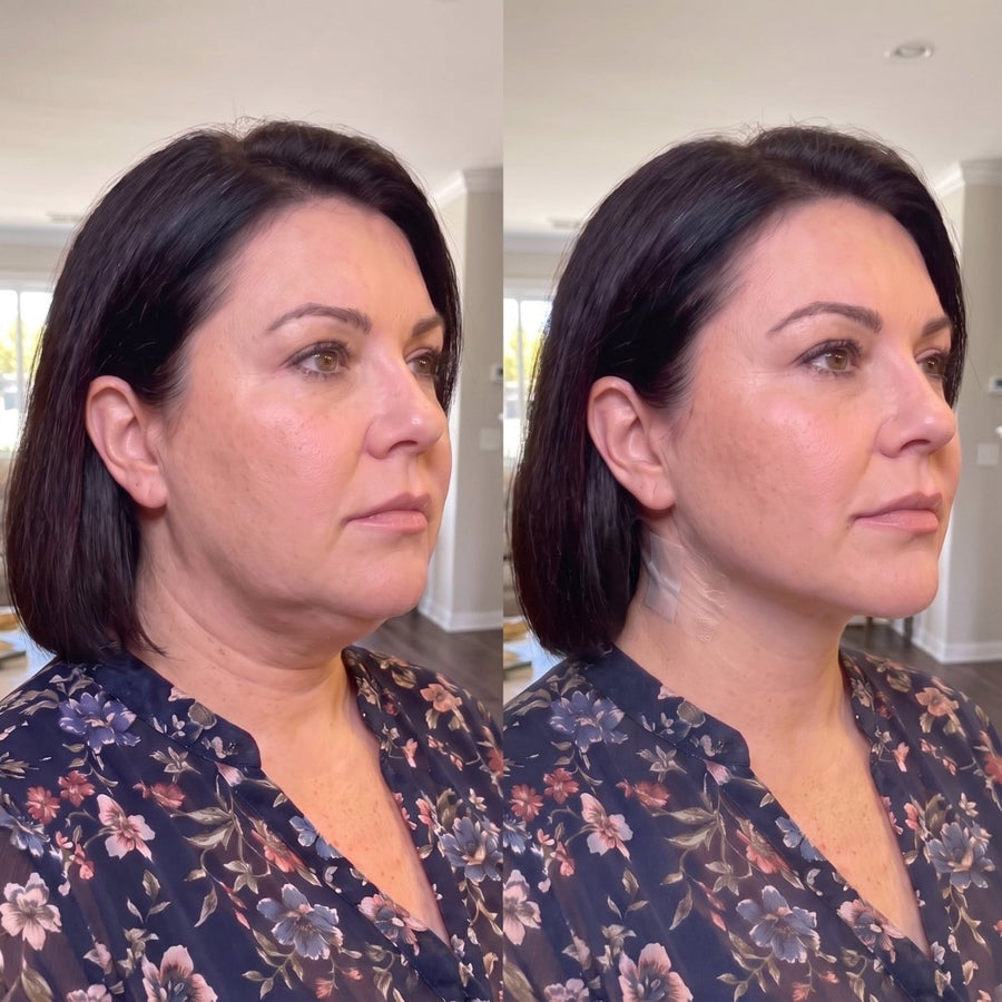 Tonee Neck by Tonee Skin - cellulite smoothing, lifting, and firming tape for