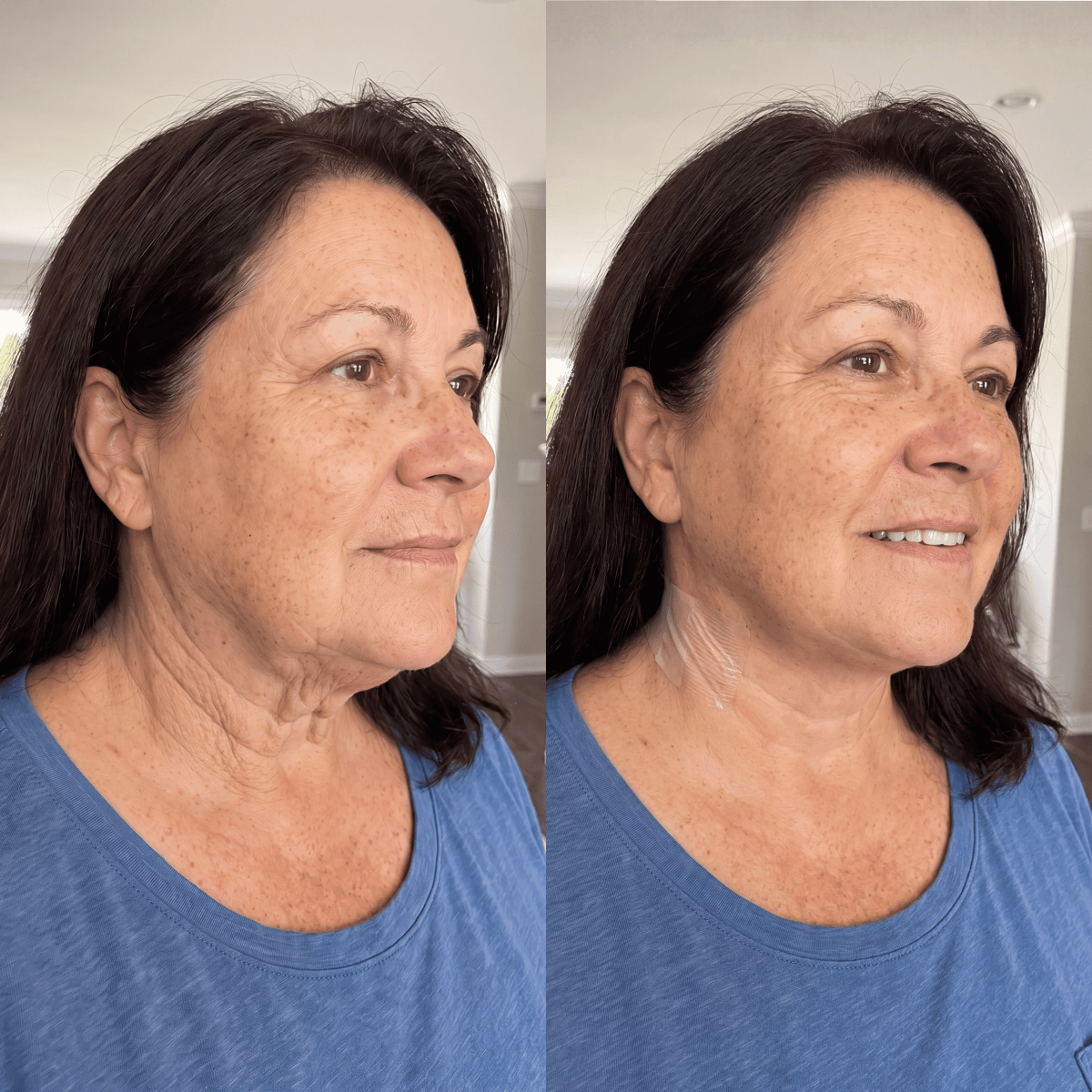 The same woman before and after wearing Tonee Neck tape
