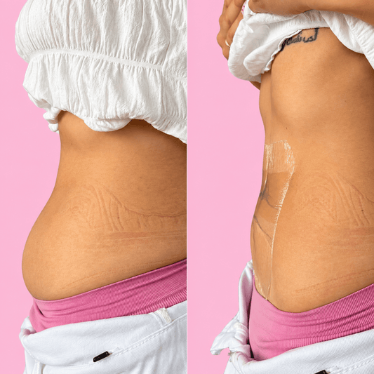 Tonee Tummy by Tonee Skin - cellulite smoothing, lifting, and firming tape for