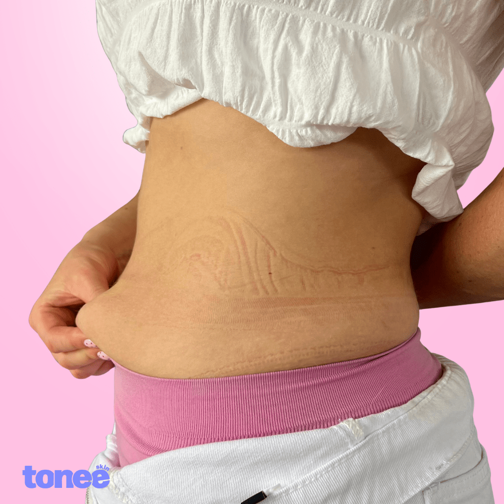 Tonee Tummy by Tonee Skin - cellulite smoothing, lifting, and firming tape for