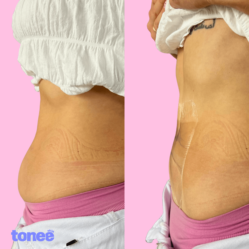 Tonee Tummy by Tonee Skin - cellulite smoothing, lifting, and firming tape for