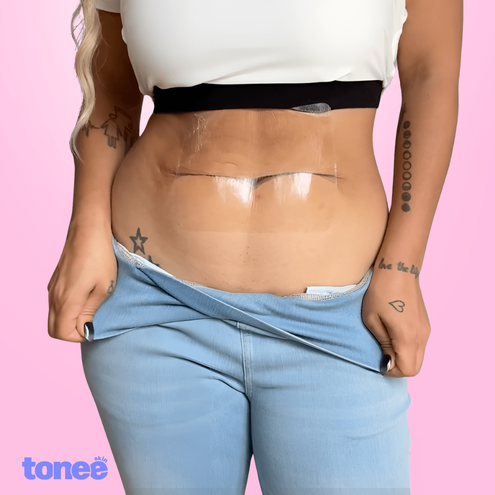 Tonee Tummy by Tonee Skin - cellulite smoothing, lifting, and firming tape for