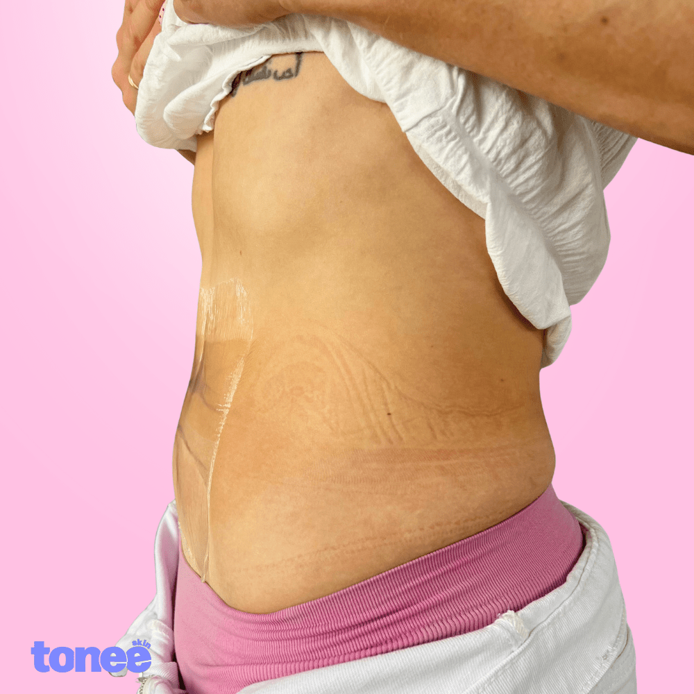 Tonee Tummy by Tonee Skin - cellulite smoothing, lifting, and firming tape for
