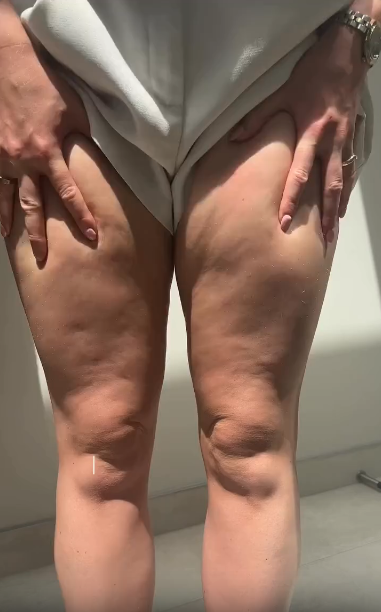 Before and after using Tonee Skin Thigh Tape showing visibly smoother, firmer legs with reduced cellulite appearance.